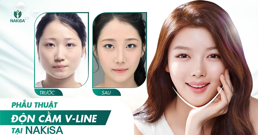 Phẫu thuật độn cằm V Line