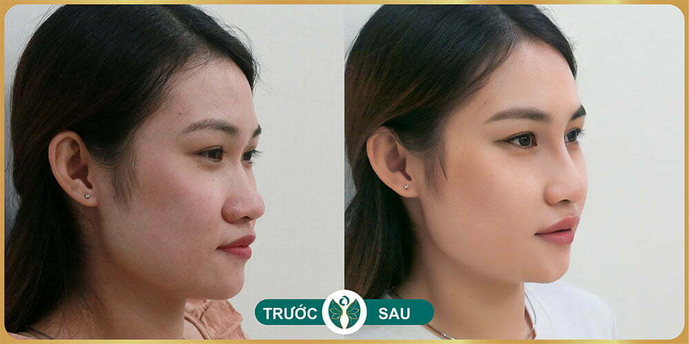 nang mui tai tham my nakisa