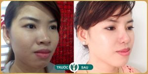 nang mui tai tham my nakisa