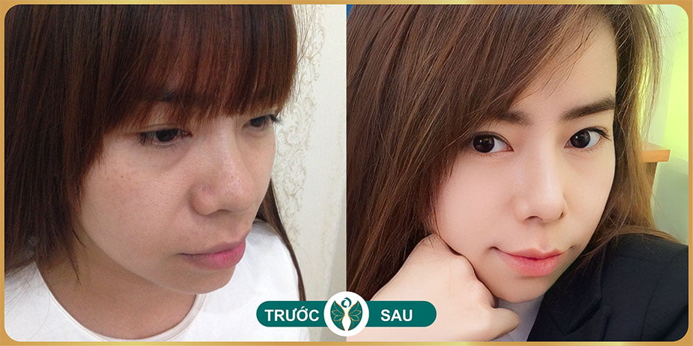 nang mui tai tham my nakisa