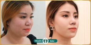 nang mui tai tham my nakisa