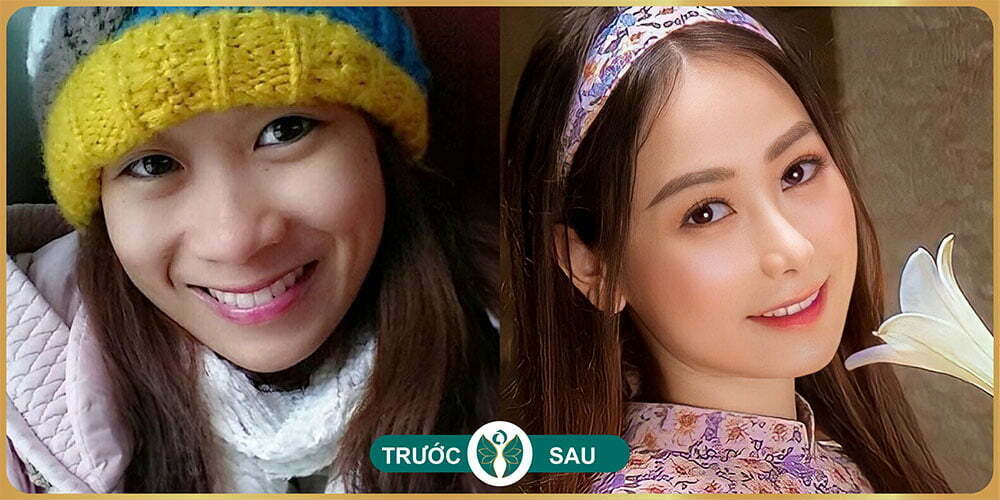 nang mui tai tham my nakisa