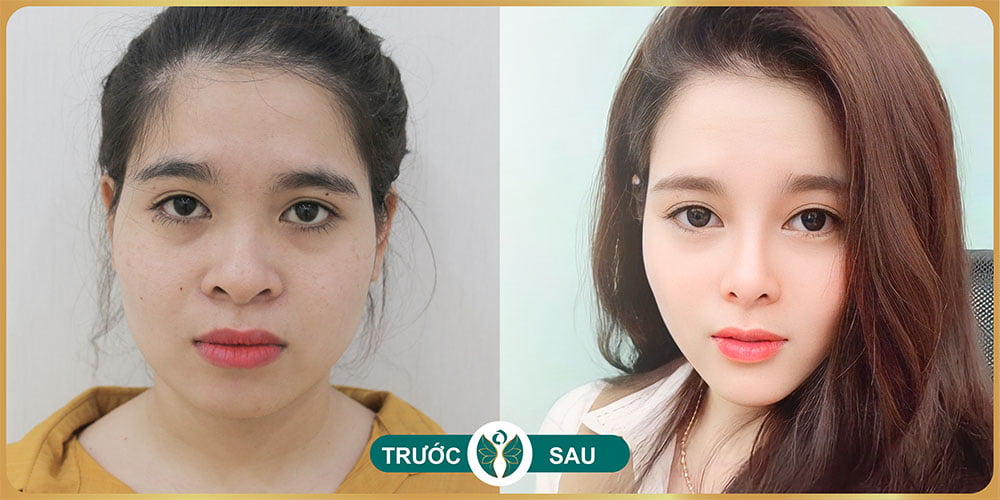 nang mui tai tham my nakisa