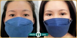 truoc va sau khi cat mat