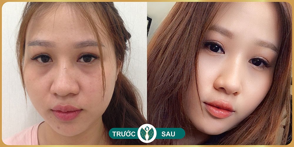 truoc va sau khi cat mat