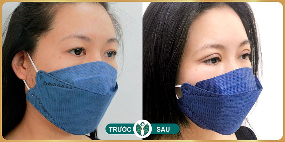 truoc va sau khi cat mat