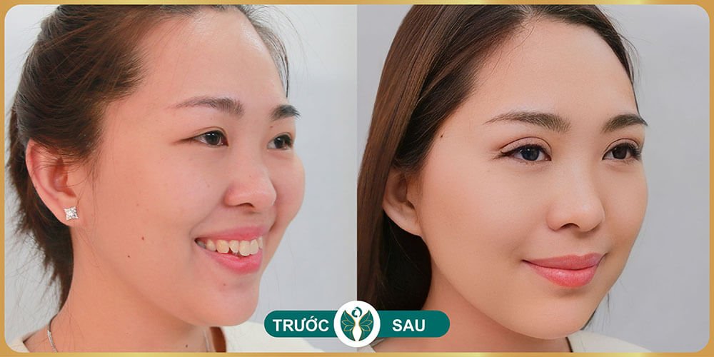 truoc va sau khi cat mat