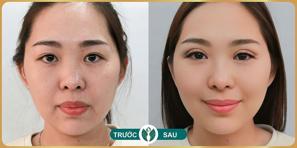 truoc va sau khi cat mat