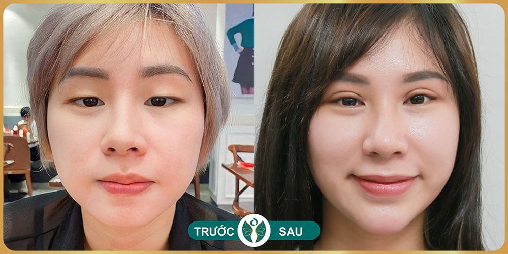 truoc va sau khi cat mat