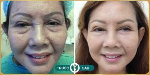 cấy mỡ mặt