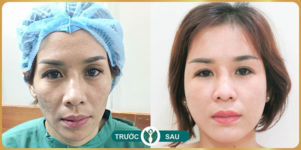 cấy mỡ mặt