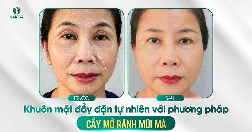 Cách xóa nếp nhăn rãnh mũi má