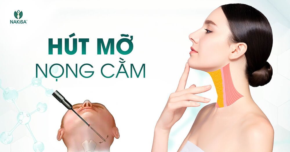 Hút mỡ nọng cằm bao lâu thì lành
