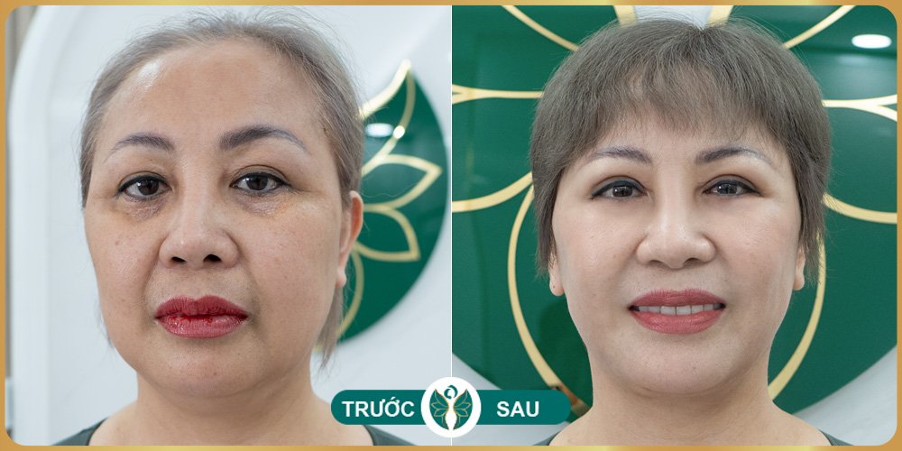 Hút mỡ nọng cằm 