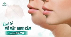 Loại bỏ mỡ mặt nọng cằm chuẩn S Line