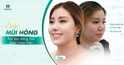 Sửa mũi hỏng - Tôn tạo dáng mũi thêm hoàn hảo
