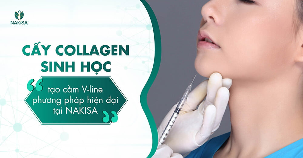 Cấy collagen sinh học tạo cằm V line