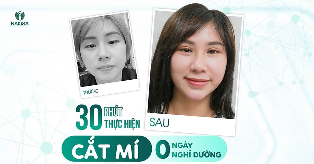 Phương pháp thẩm mỹ mắt tại NAKISA