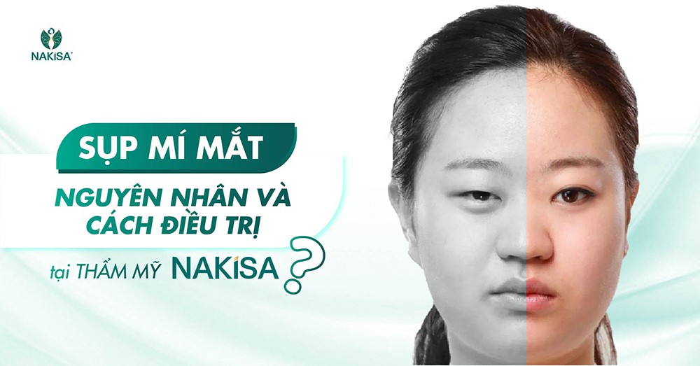 Điều trị sụp mí mắt