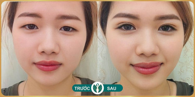 Hình ảnh trước sau khi cắt mắt hai mí