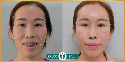 Hình ảnh trước sau khi cấy mỡ má hóp