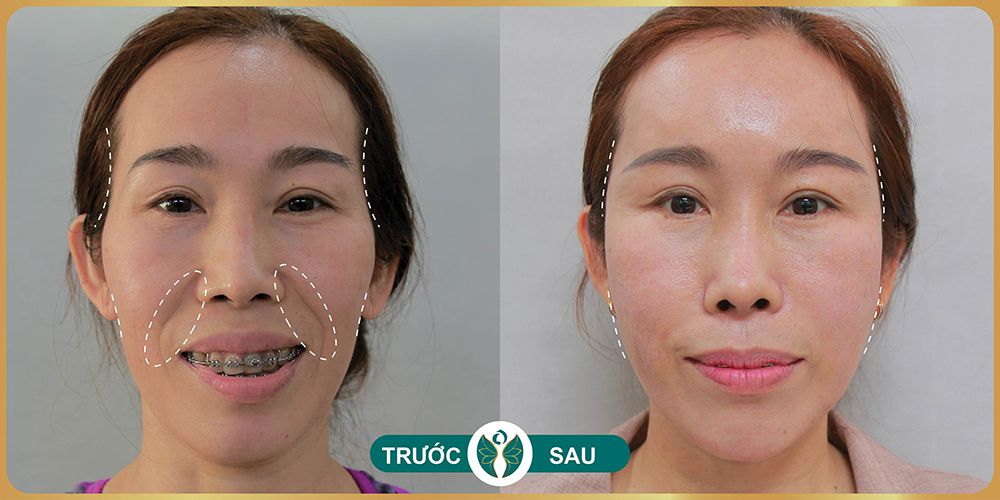Cấy collagen làm đầy má hóp