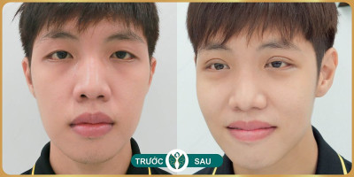 Hình ảnh trước sau khi nhấn mí mắt