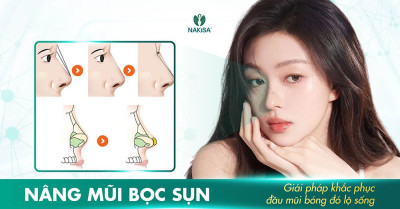 Nâng mũi bọc sụn