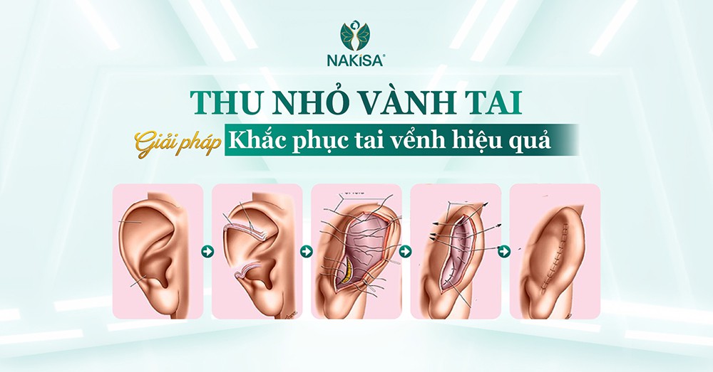 Thu nhỏ vành tai - Giải pháp khắc phục tai vểnh hiệu quả tại Thẩm mỹ NAKiSA