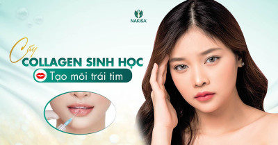 Cấy collagen sinh học tạo môi trái tim