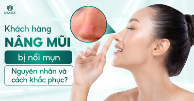 Khách hàng nâng mũi bị nổi mụn: Nguyên nhân và cách khắc phục