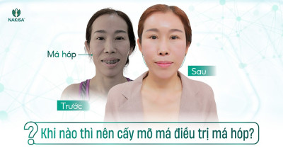 Khi nào thì nên cấy mỡ má điều trị má hóp