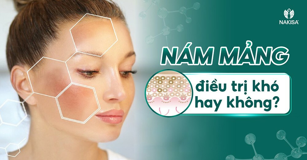 Nám mảng điều trị khó hay không