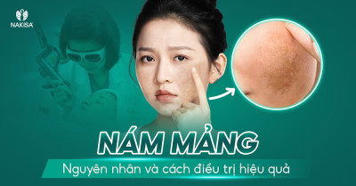 Nám mảng: Nguyên nhân và cách điều trị hiệu quả