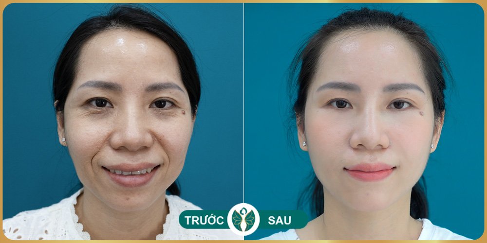Cấy collagen tươi vào mặt có tốt không